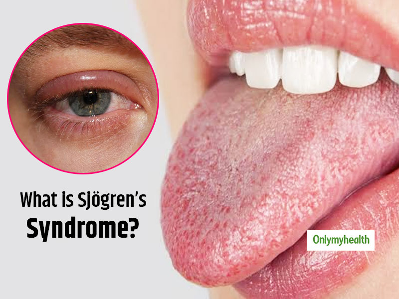 What Is Sjögren’s Syndrome? Here's Everything You Should Know